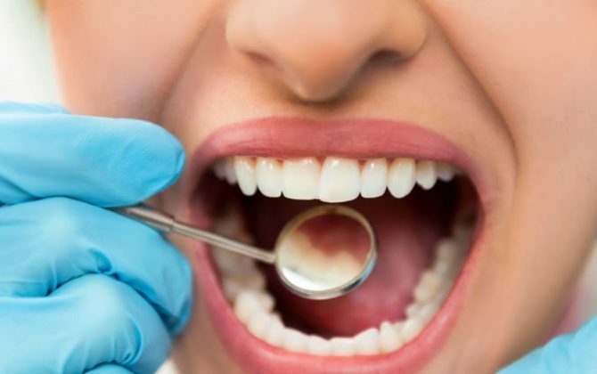 تسوس الأسنان وطرق علاجها 2022